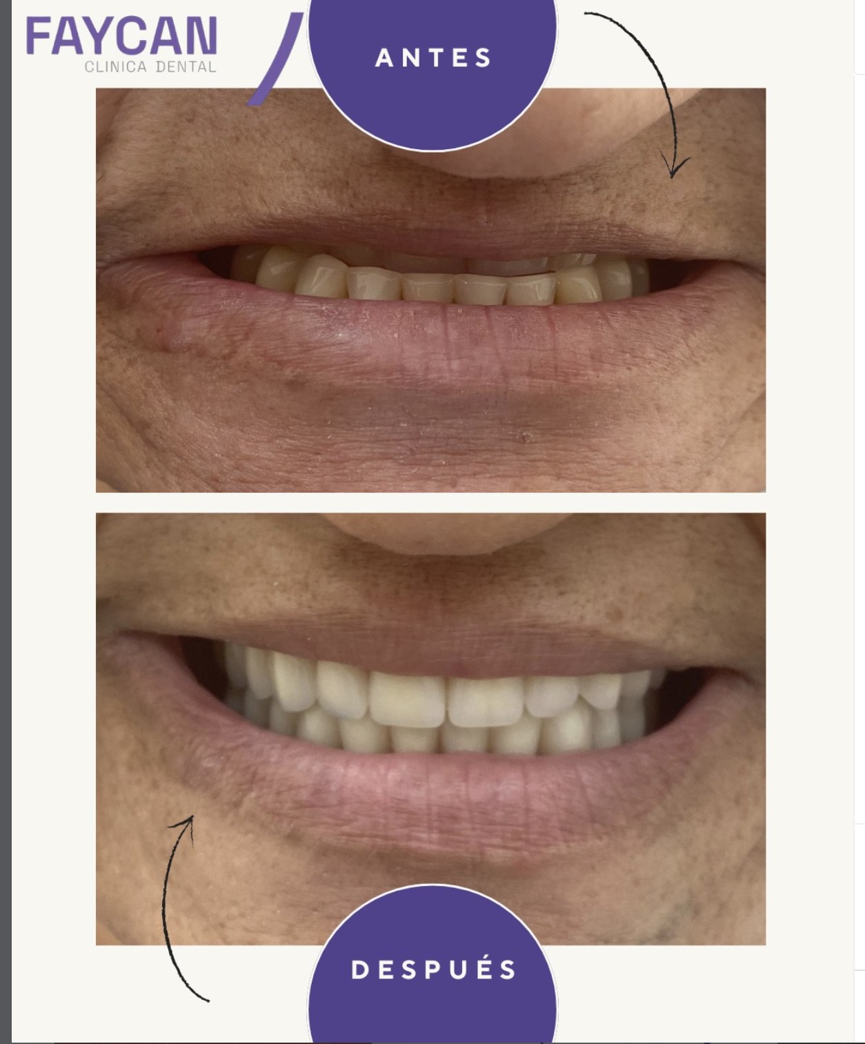 Caso real antes y después - Clínica Dental Faycan