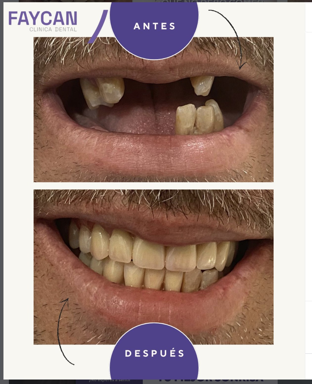 Caso real antes y después - Clínica Dental Faycan