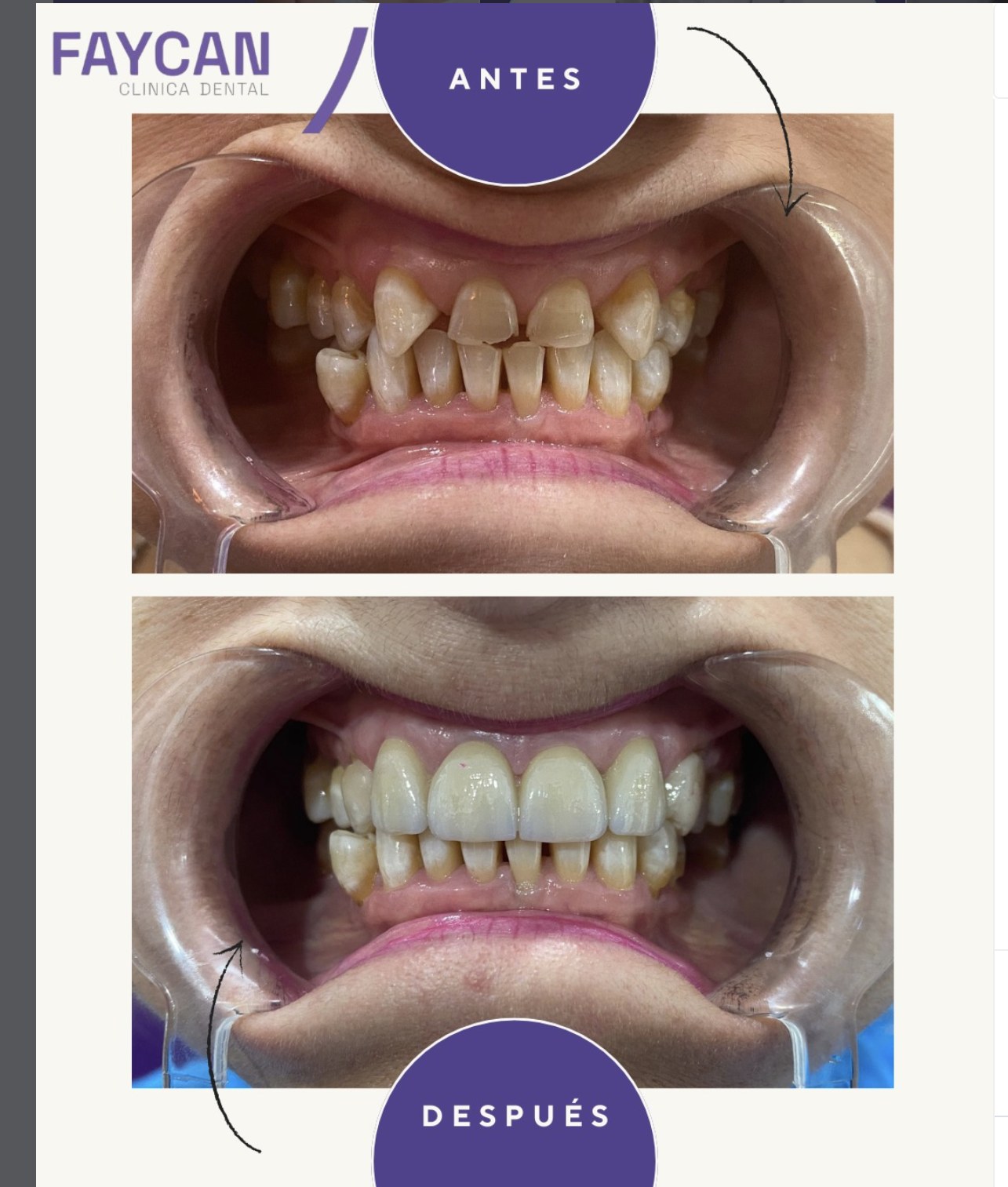 Caso real antes y después - Clínica Dental Faycan