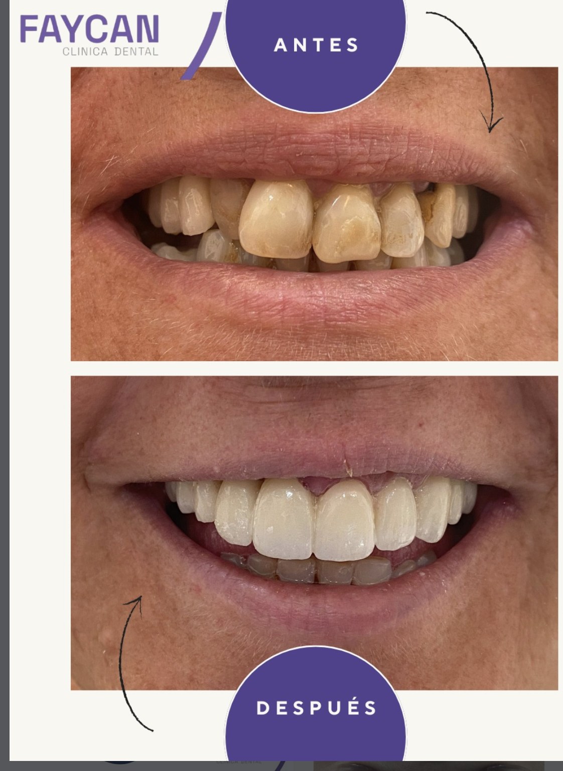 Caso real antes y después - Clínica Dental Faycan