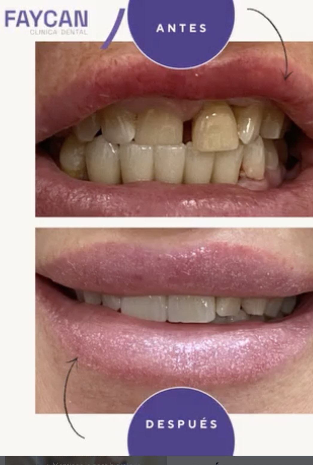 Caso real antes y después - Clínica Dental Faycan