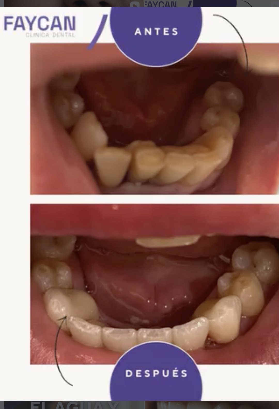Caso real antes y después - Clínica Dental Faycan