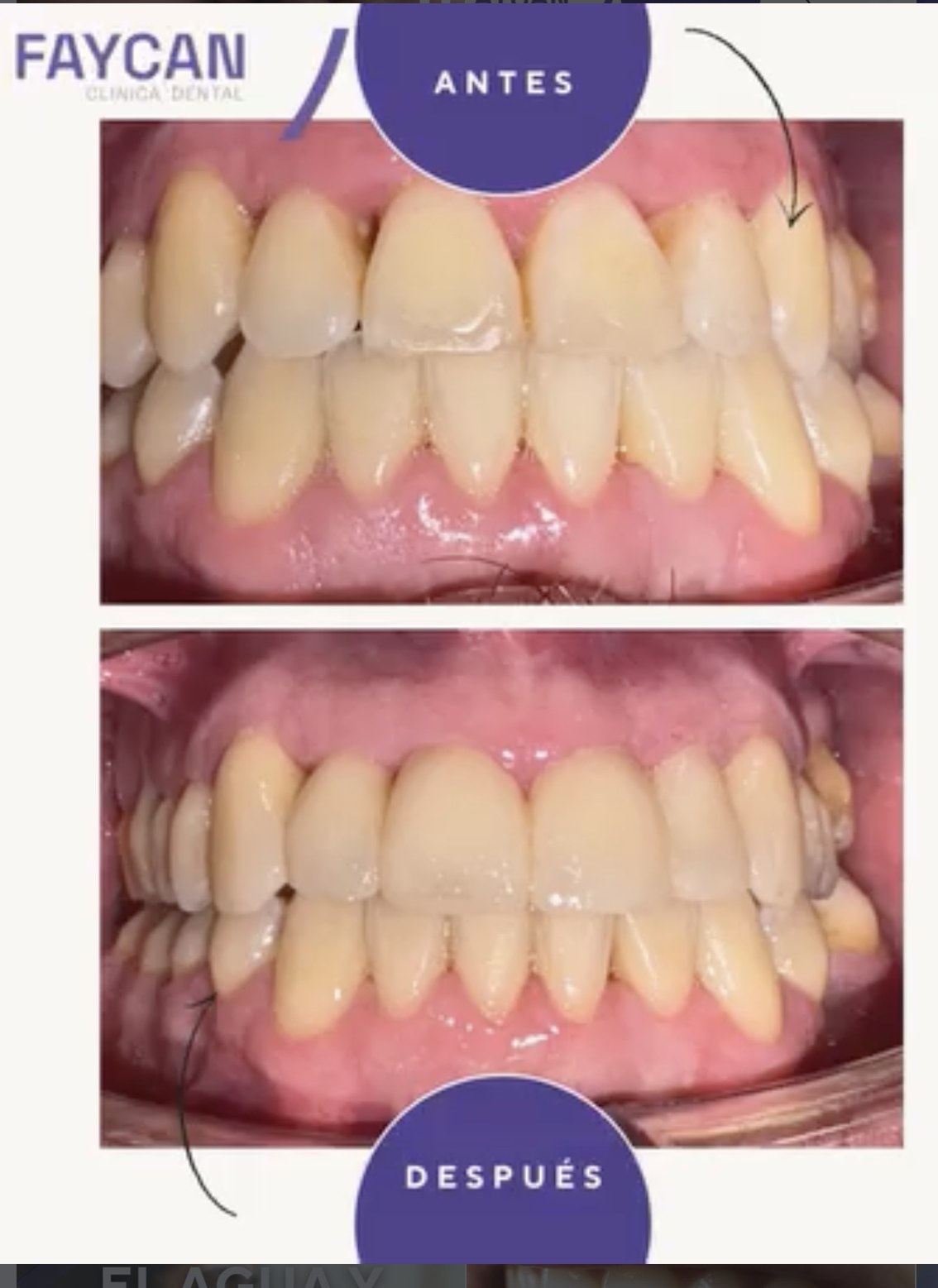 Caso real antes y después - Clínica Dental Faycan