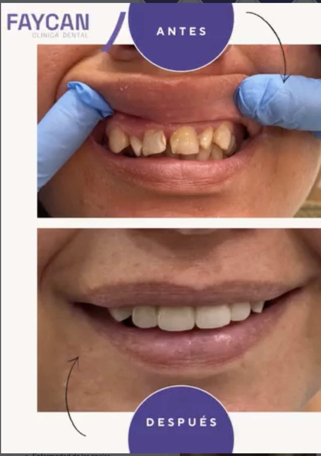 Caso real antes y después - Clínica Dental Faycan