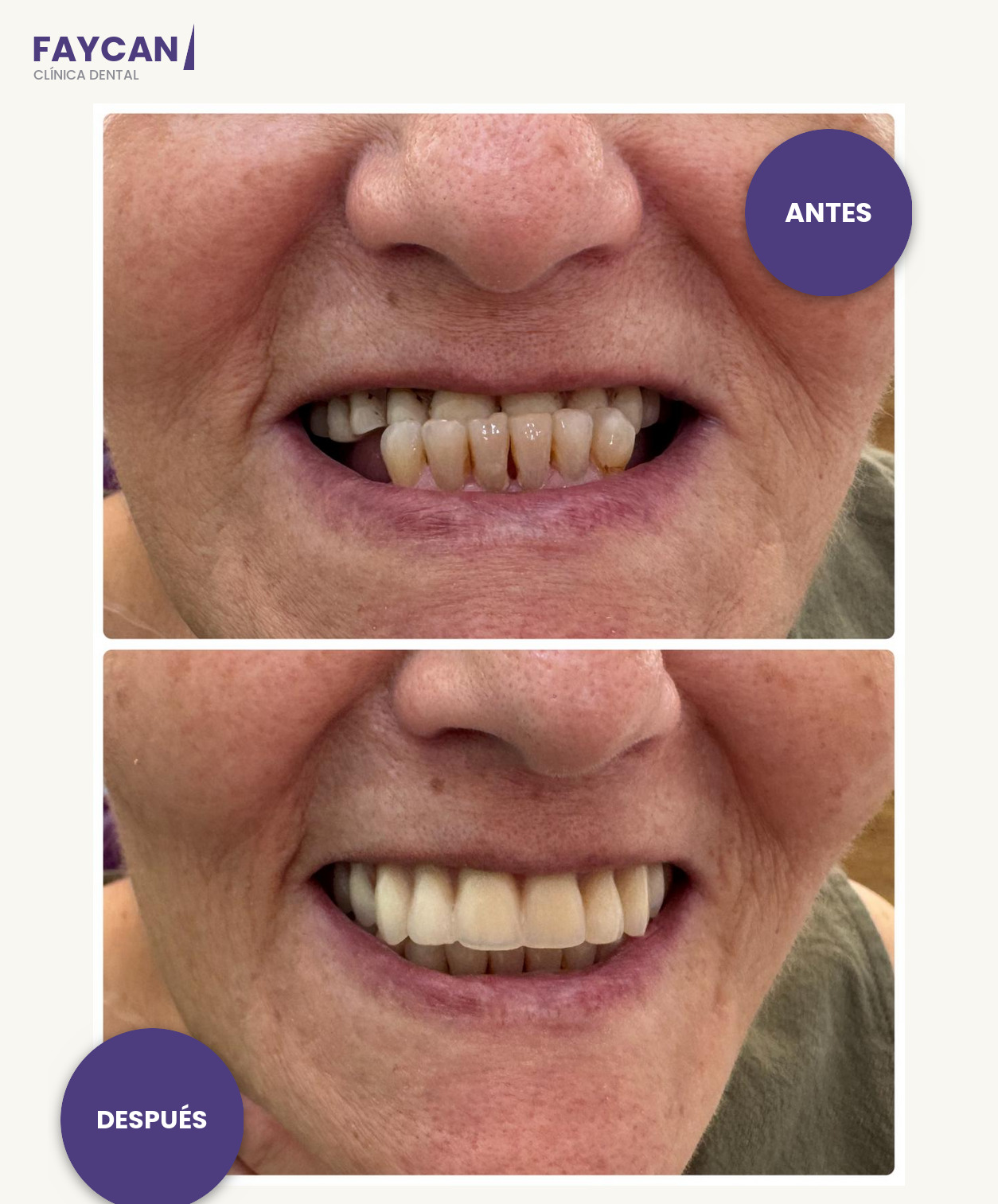 Caso real antes y después - rehabilitación completa - Clínica Dental Faycan